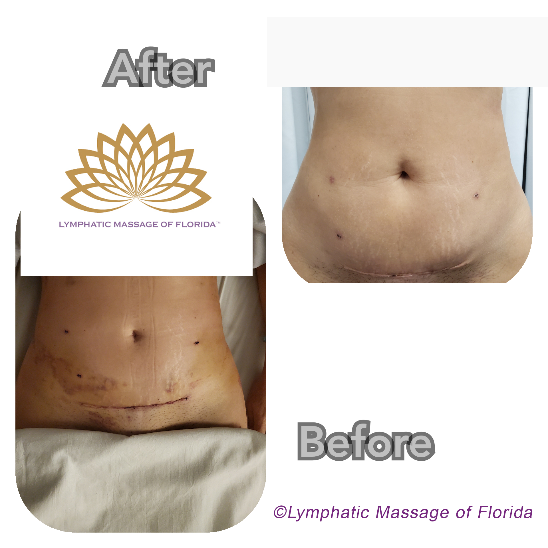 Tummy Tuck Post Surgical Benefits - Lymphatic Massage of Florida