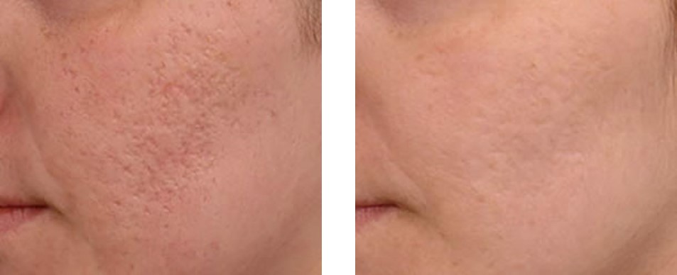 Acne scars affect at different ages