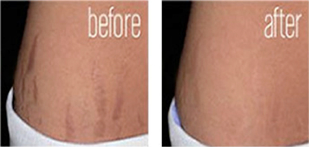 Reduce appearance of stretch marks on the hips, abdomen.